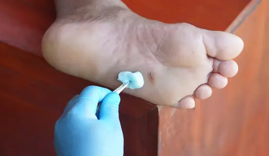 10 Cara Merawat Luka Lecet Kecil di Kaki